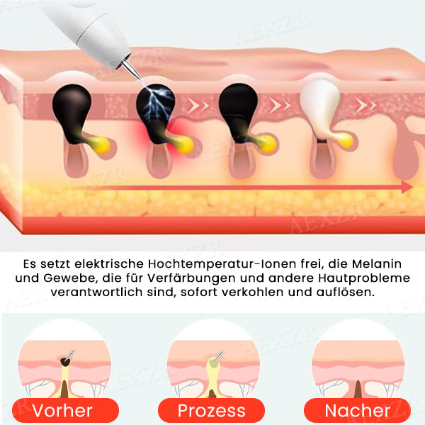 1+1 GRATIS | LuminSkin™ Verabschieden Sie sich von Hautunreinheiten