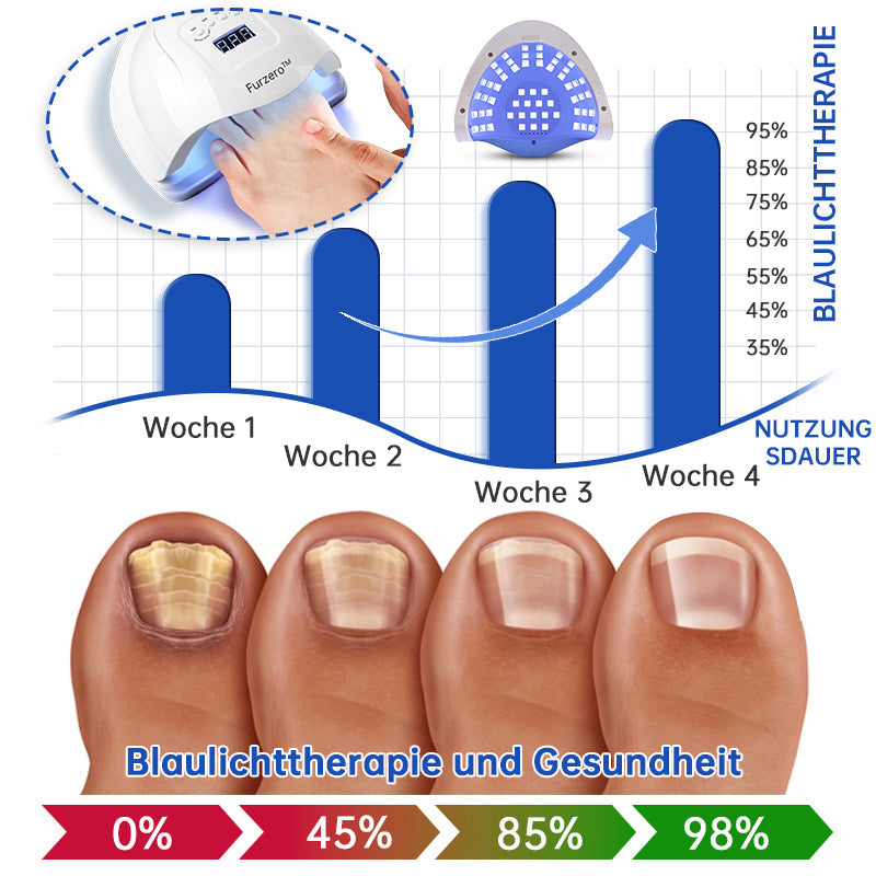 PureNail™ | Pilz-Lasertherapiegerät - Ihre Geheimwaffe gegen Nagelpilz