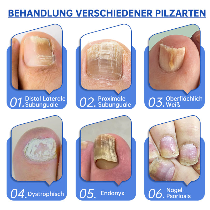 PureNail™ | Pilz-Lasertherapiegerät - Ihre Geheimwaffe gegen Nagelpilz