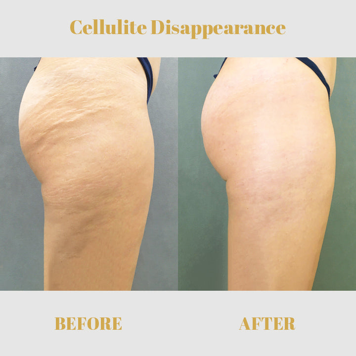 1+1 GRATIS | PeachyBum™, Reduziert die Sichtbarkeit von Cellulite