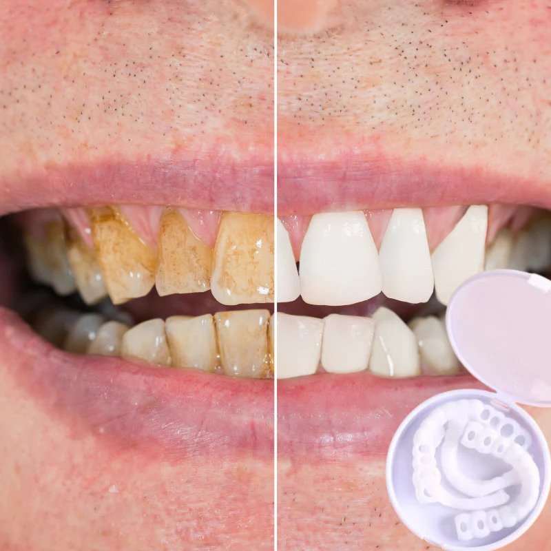 SmileEZ™ – Sofortige Lächeln-Transformation